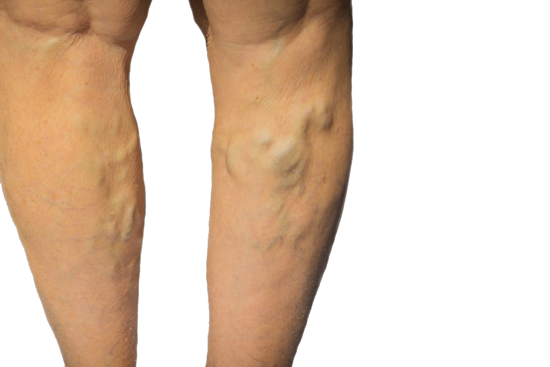 Dr. Todd Kobrinski is a board-certified vein doctor in Freehold, New Jersey. In this article, our vascular surgeon discusses minimally invasive varicose vein treatments.