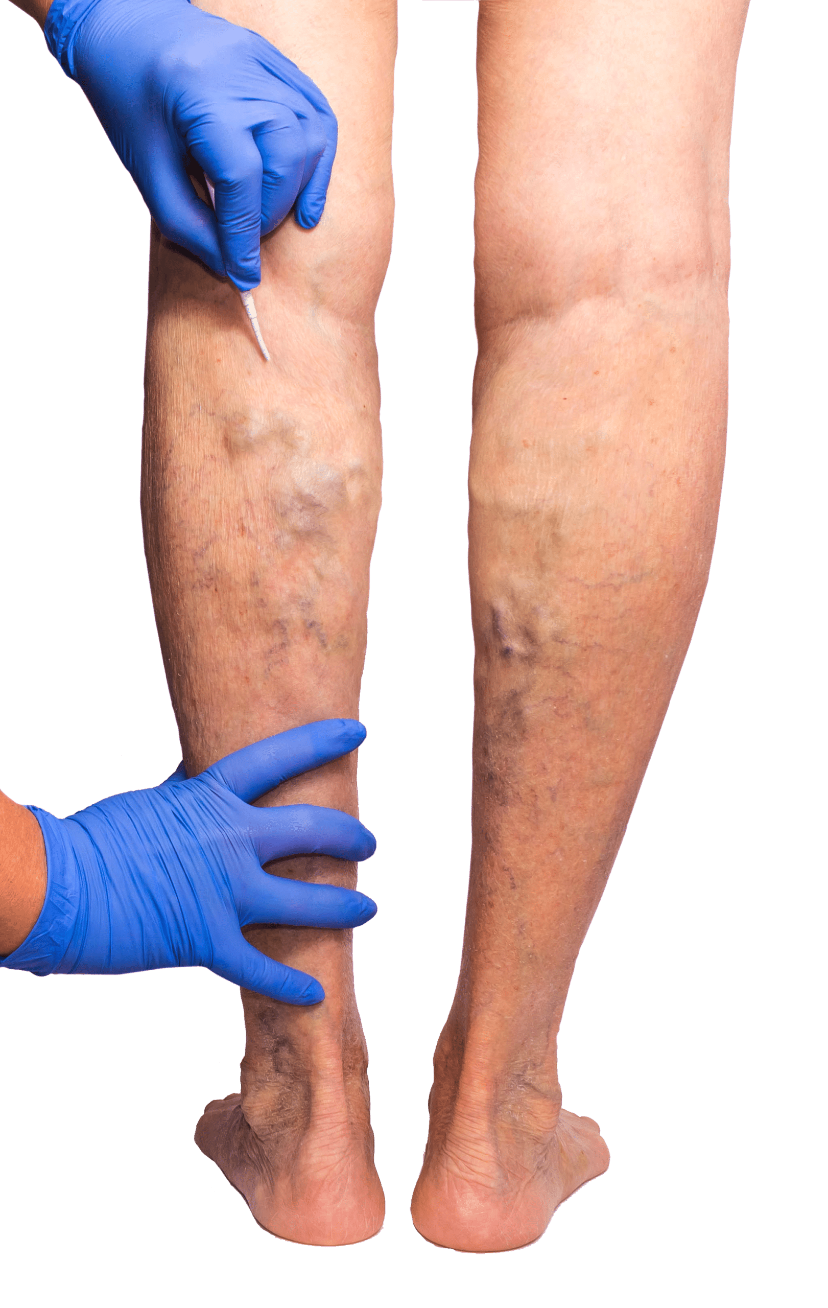  Are you looking for the best vein doctor near me in Paramus, NJ? This article introduces you to the best vein doctor and vein center in Paramus, New Jersey.