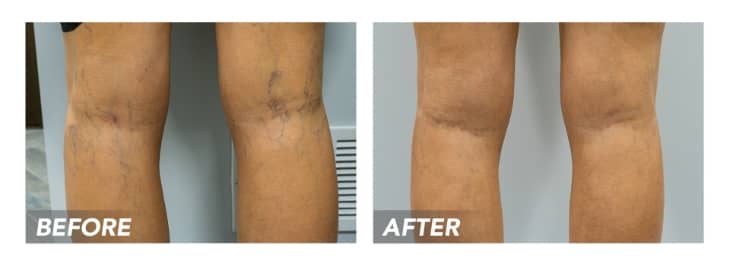 Before-After-SpiderVeins-Patient