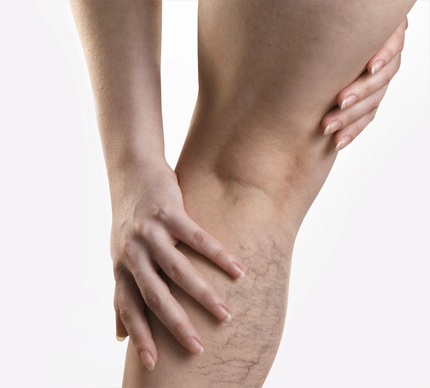 vipcenters_SpiderVeins_treatment_img1