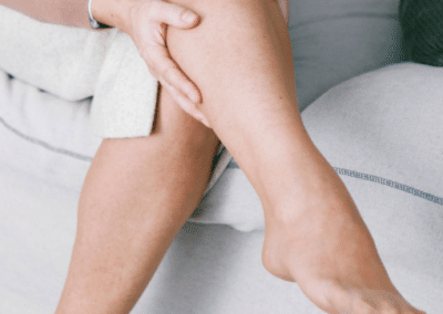 varicose vein treatment